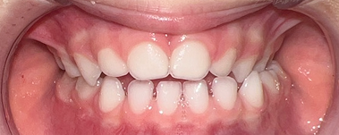 Snoring stopped, after